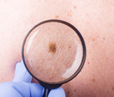 Skin Cancer Surveillance & Treatment