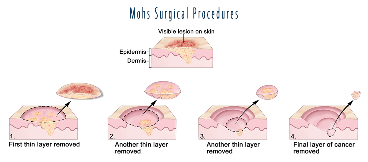 MOHS Surgical Procedures Example